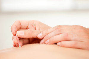 Acupuncture needling, guide tube, accupuncture, 